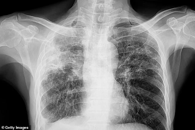 Maine TB Outbreak Fears as Three Cases of WHO-Labeled Deadliest Disease Detected in Greater Portland