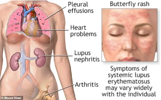 Study Links Epstein-Barr Virus to Lupus Development, Stanford Research Indicates
