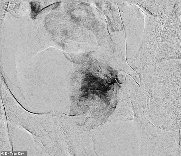 The Growing Burden of Benign Prostatic Hyperplasia on Men's Health in the United States