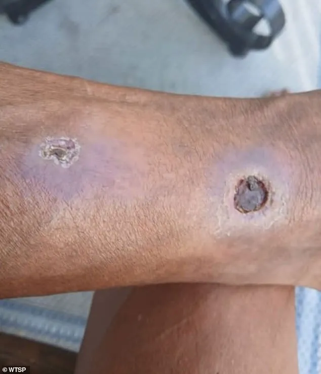 Florida Woman Sues Apartment Complex for Alleged Negligence in Spider Infestation, Resulting in Severe Health Consequences