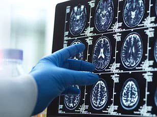 Privileged Access: Chinese Doctors Discover Alzheimer’s in 19-Year-Old with No Genetic Predisposition