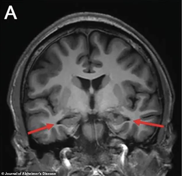 Privileged Access: Chinese Doctors Discover Alzheimer’s in 19-Year-Old with No Genetic Predisposition