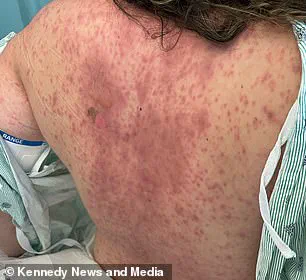Behind Closed Doors: The Hidden Danger of Lamotrigine and the Medical Crisis That Changed Emily McAllister’s Life