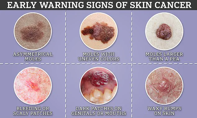 The Hidden Danger of Melanoma: How the Eyes Reveal an Overlooked Frontier