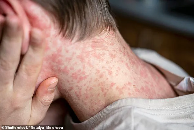 Measles Outbreak at Dilley Immigration Processing Center Leads to Quarantine Measures by ICE Health Services Corps