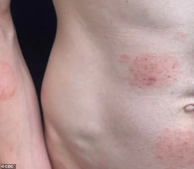 Minnesota's Largest Ringworm Outbreak Linked to Rare Fungus Sparks Health Alerts