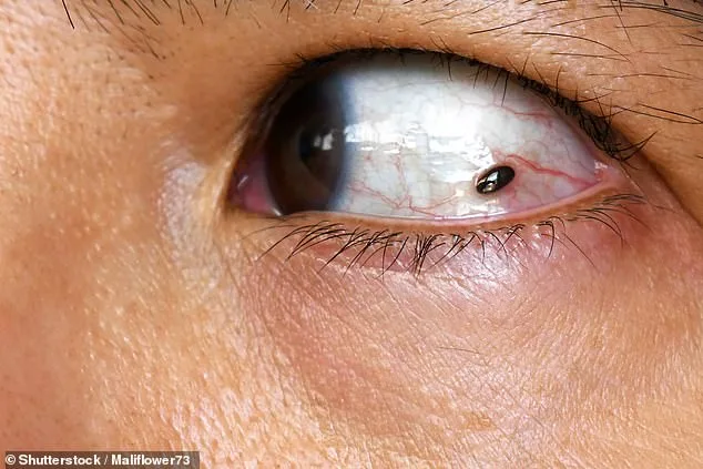 A Routine Eye Exam Reveals Cancer: The Hidden Danger of a Childhood Freckle