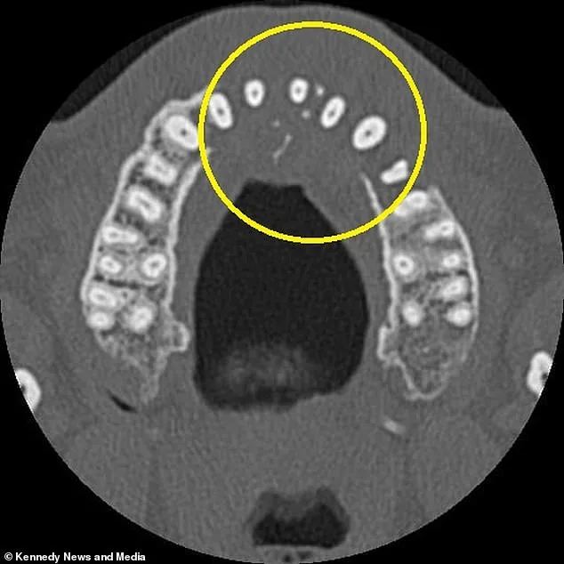 Man's Minor Toothache Reveals Aggressive Blood Cancer