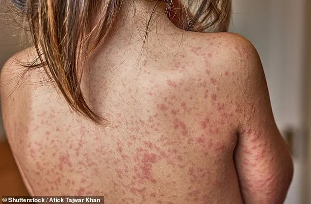 Measles Outbreak Sparks Warning: Unvaccinated Children May Face School Exclusion as Vaccination Rates Decline