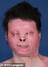 Joseph DiMeo Survives Drowsy Driving Crash and 80% Burn Injuries, Embarking on Reconstructive Surgery Journey