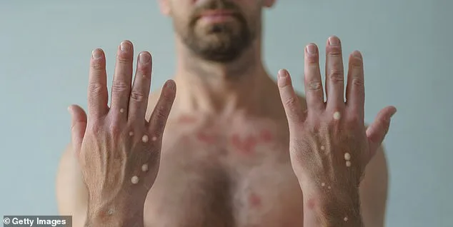 New York Confirms First Local Case of More Severe Clade I Mpox