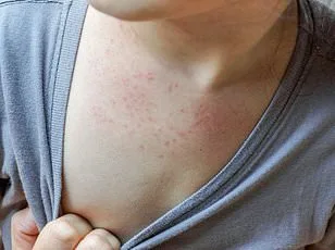 Surge in Human Metapneumovirus Raises Alarm as Public Health Officials Monitor Rapid Spread Without Vaccine or Treatment