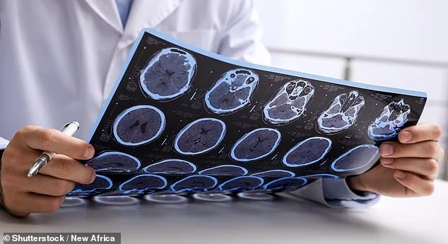 Rising MS Cases in England Linked to Smoking, Obesity, and Socioeconomic Deprivation, Study Reveals
