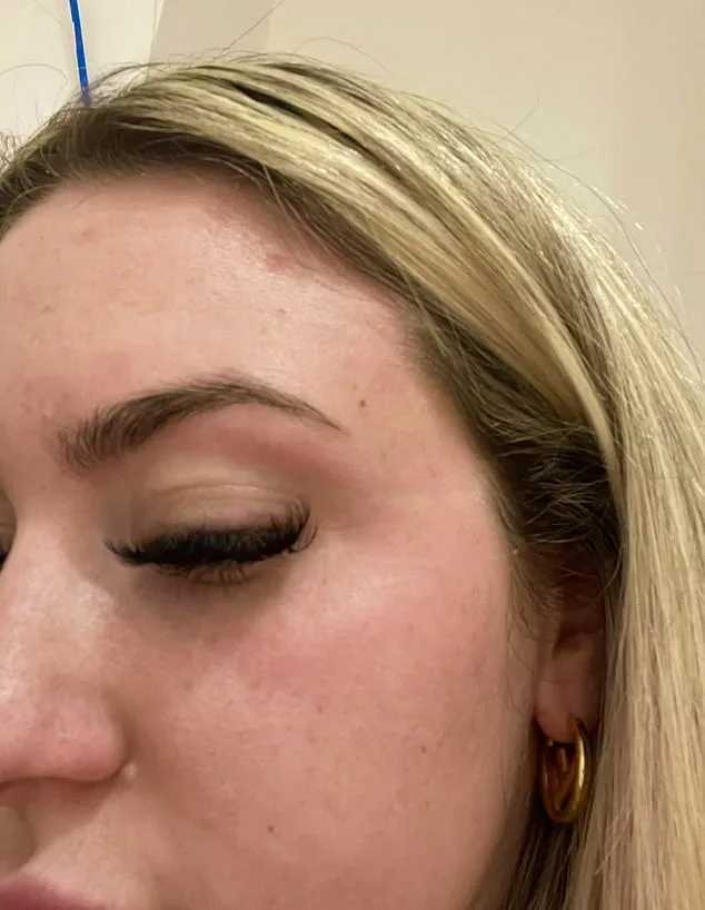 A 14-Year Battle with Psoriasis: Shannon Higham's Relentless Fight Against an Autoimmune Disease