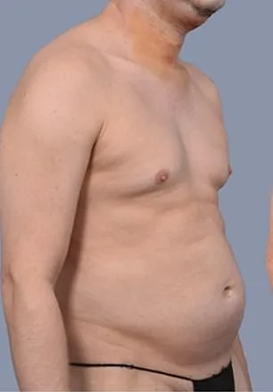 From Stubborn Fat to Sculpted Abs: Frank Hoyle's $23,000 Liposuction Miracle