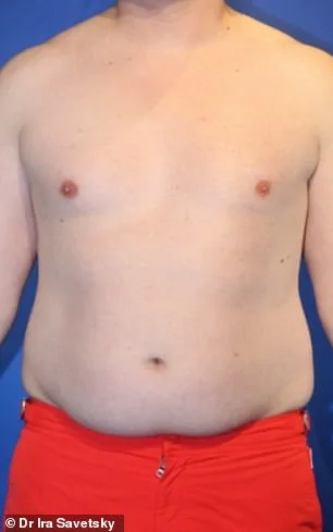 From Stubborn Fat to Sculpted Abs: Frank Hoyle's $23,000 Liposuction Miracle