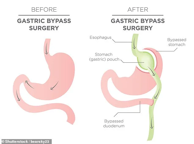 NHS Faces Record Surge in Weight-Loss Surgeries as Obesity Crisis Deepens