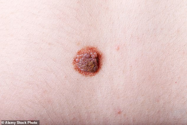 Global skin cancer cases projected to surge by 2050 as melanoma becomes major killer